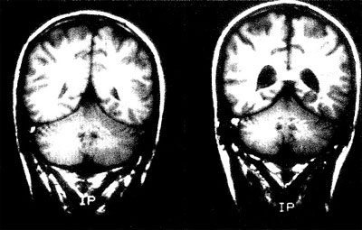 schizophrenia brain ventricles